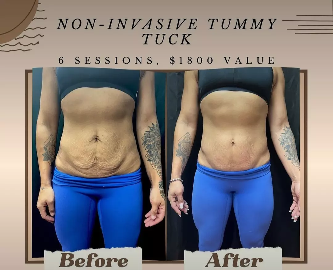 Up to 43% Off on Lipo - Non-Invasive Laser-iLipo at Illusionsmedispa llc - Primary Image