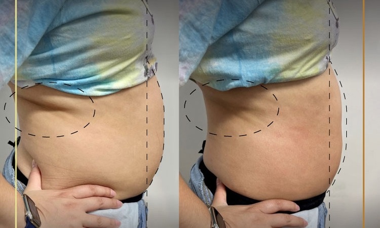 Ultrasonic Fat Reduction: Targeted Sessions for Body Contouring