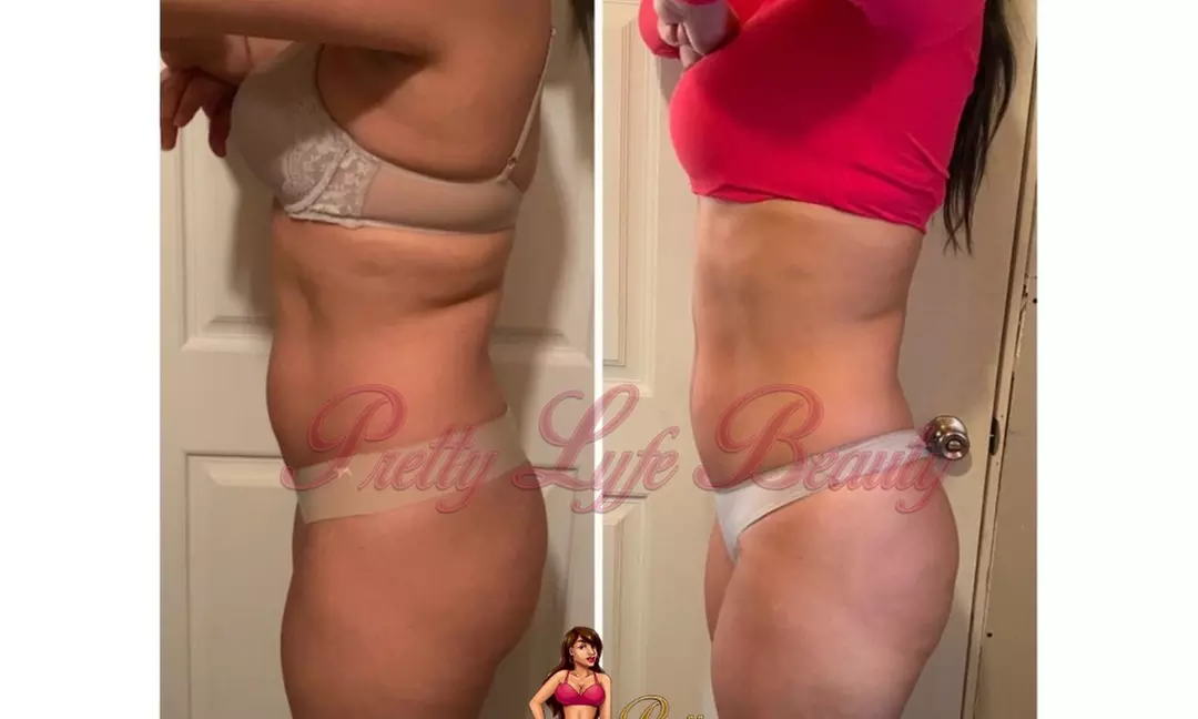 Up to 70% Off on Fat Reduction - Non-Branded at Pretty Lyfe Esthetics - Primary Image