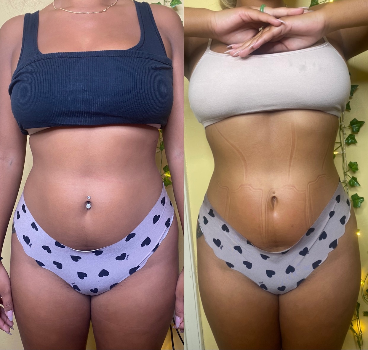 Body Sculpting Sessions with Cavitation and Radio Frequency