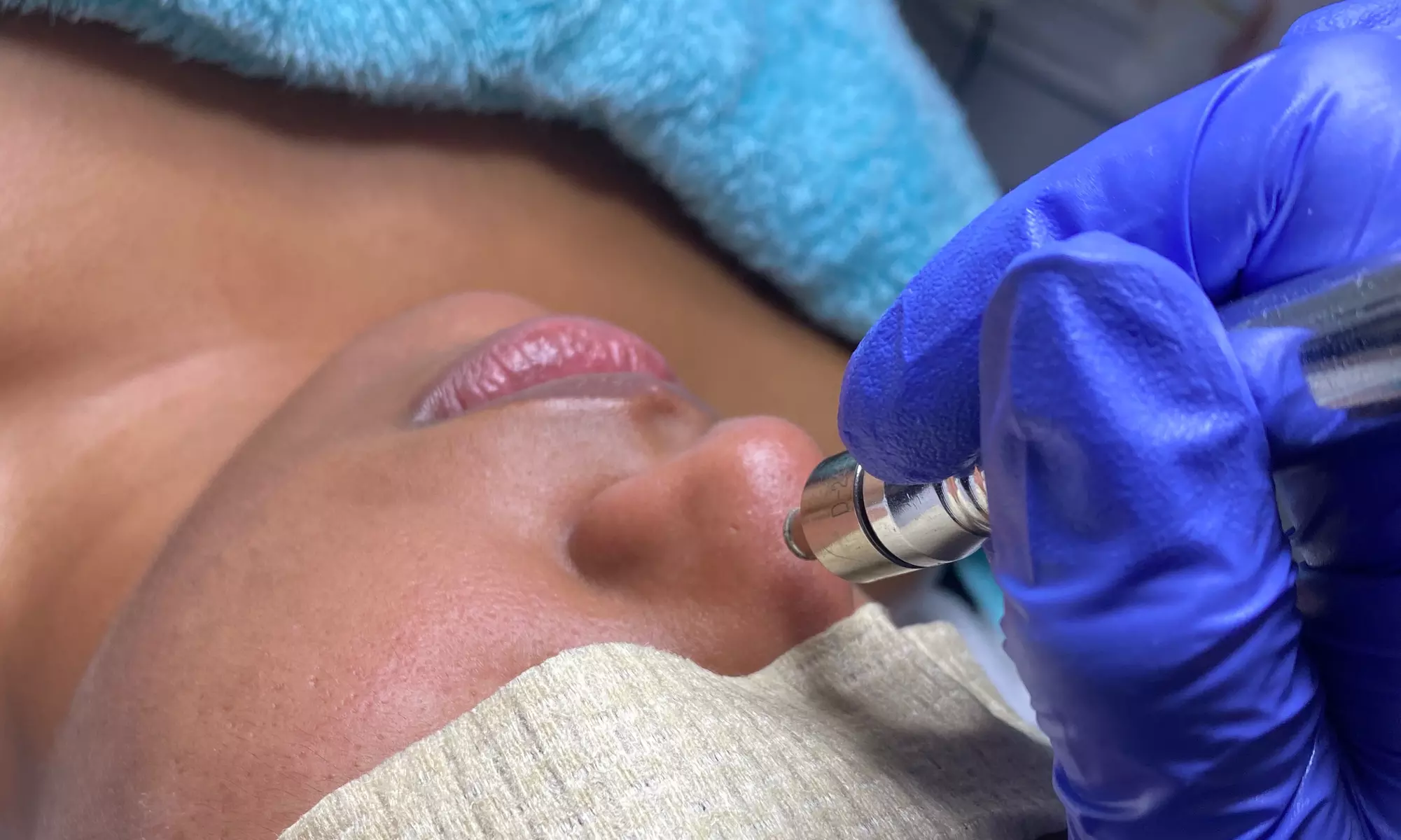 Up to 22% Off on Microdermabrasion at Optimal Skin - Primary Image