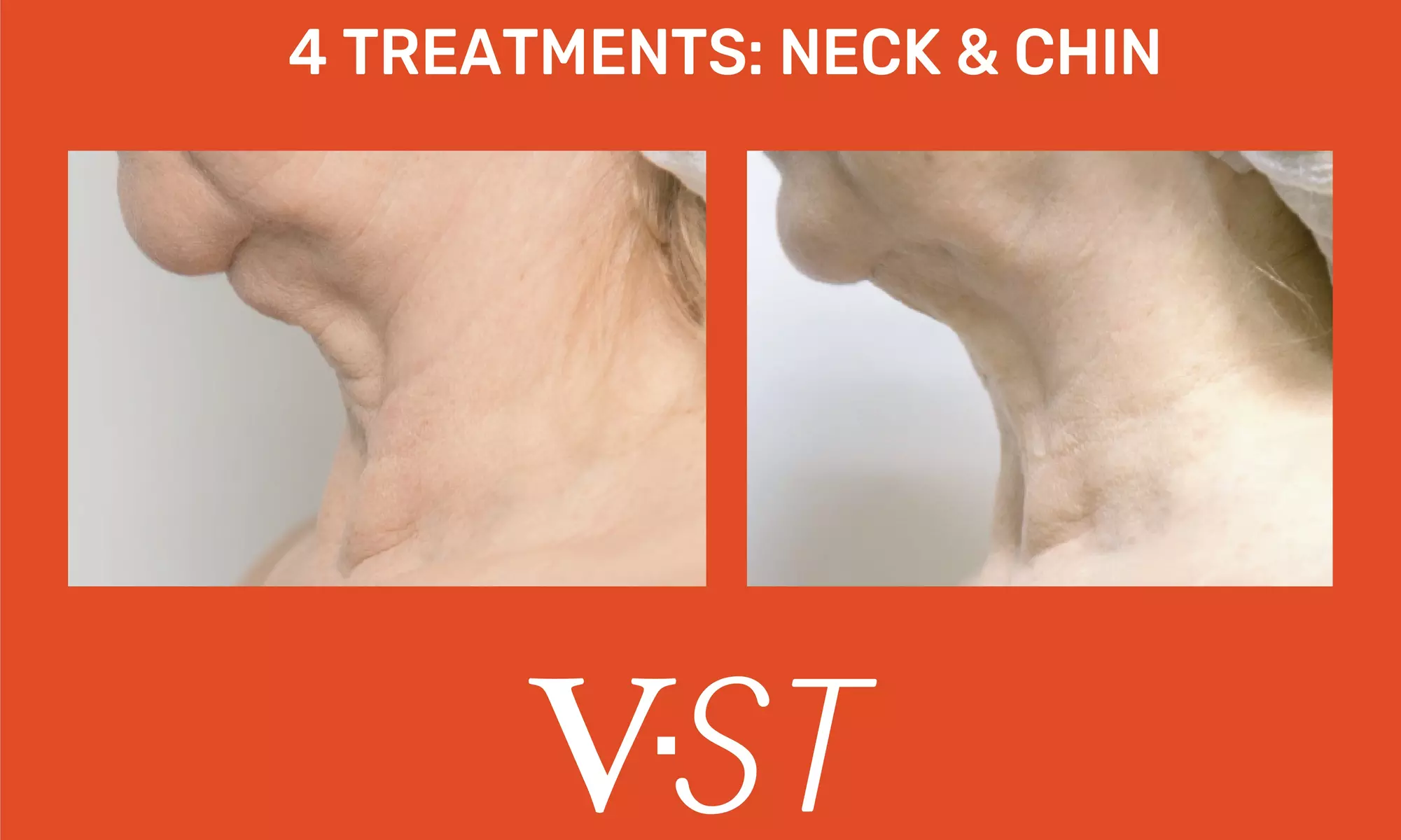 Nirvana Aesthetics And Wellness offers skin tightening on face, hands, and neck with up to 74% off - Second Medium