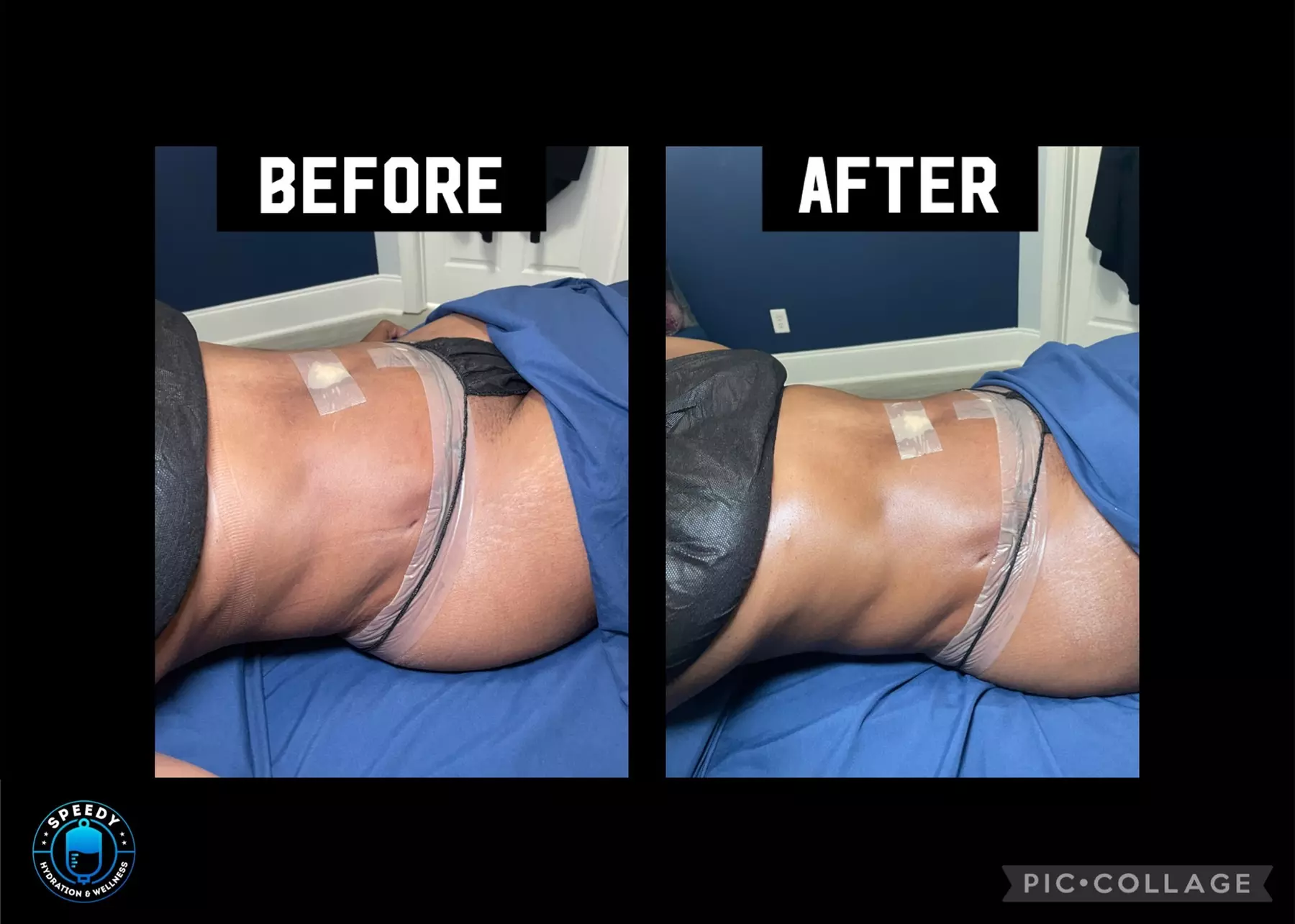 Up to 47% Off on Lymphatic Drainage Massage at Speedy Hydration & Wellness