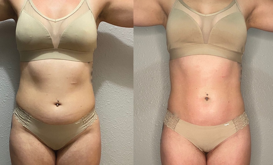 Image 1: 1, 2, 3 or 4 45 Min Ultrasonic Cavitation with Red Light Therapy 