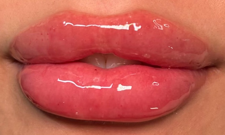 Image 1: Needle-Free Lip Plumping with Hyaluron Pen (1–2ML Options) 