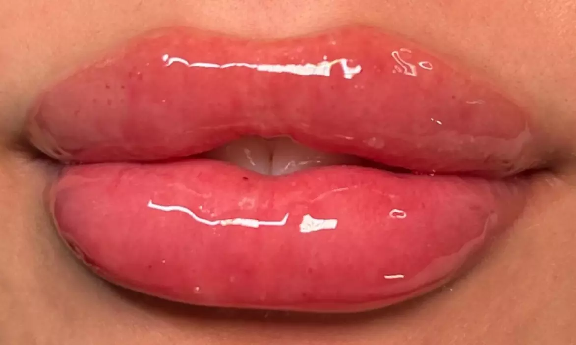 Hyaluron Pen Lip Filler for Smooth, Fuller Lips up to 30% off - Primary Image
