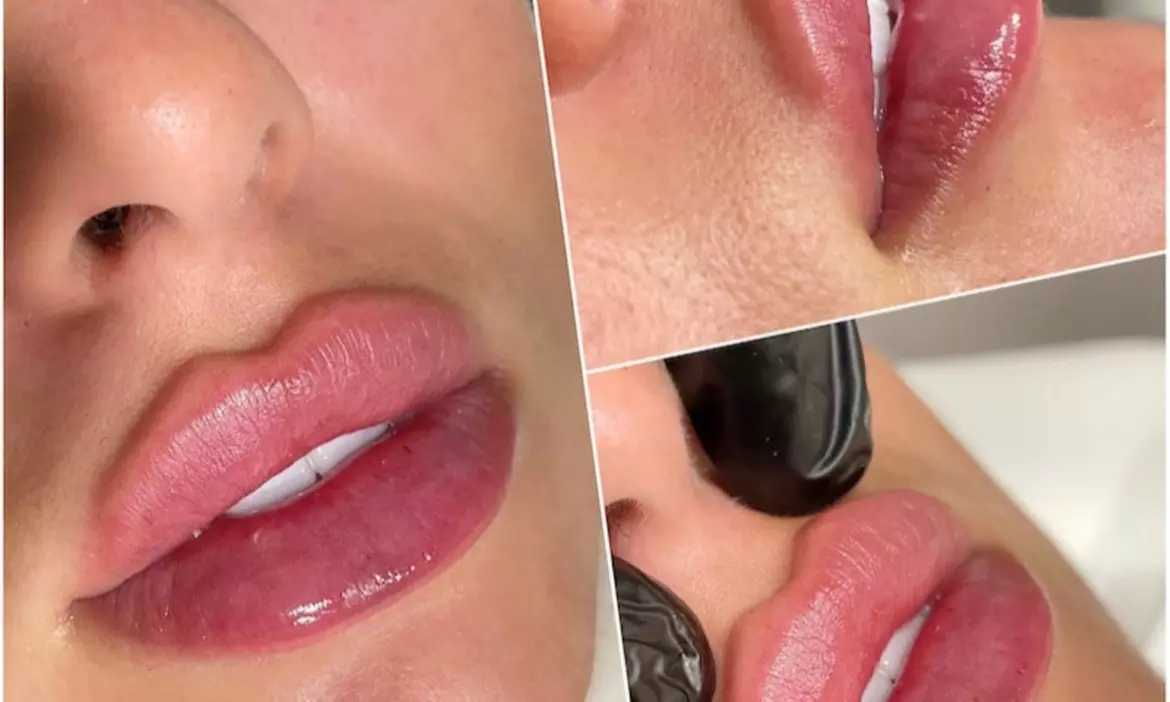 Up to 72% Off on Injection - Dermal Filler at Vanity Box