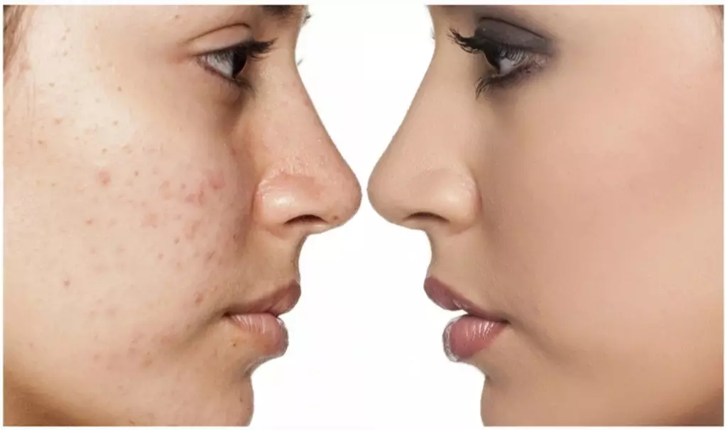 Up to 52% Off on BB Glow Facial Treatment at My Face Place - Primary Image