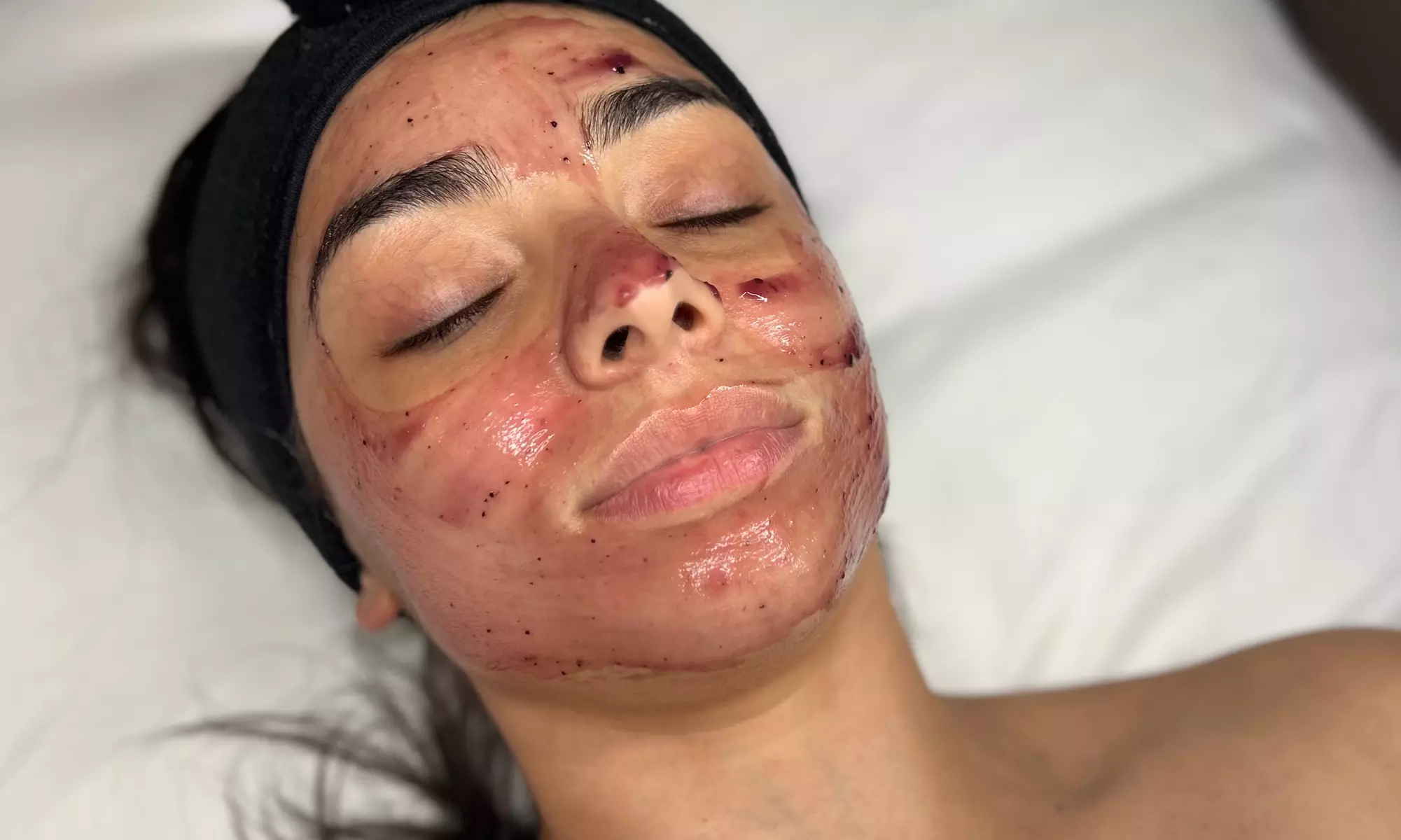 One or Three Exfoliating Facials at PureVee Esthetics - Up to 45% Off - Primary Image