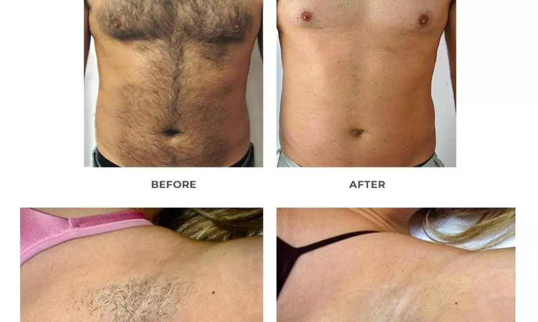 Up to 77% Off on Laser Hair Removal at Dr.Kwang Lee Wellness Center INC  - Primary Image