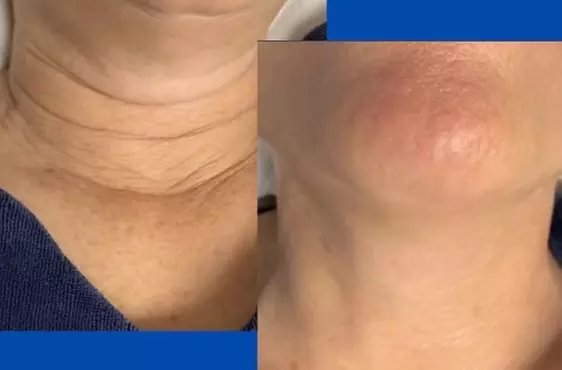 Experience up to 40% off at Imakeupplus with HIFU treatments