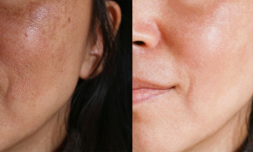 Image 1: 1 or 3 PicoWay Resolve Fusion - Melasma or Pigmented Lesions