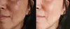 Transform with 1 or 3 PicoWay Resolve Fusion Treatment for Melasma or Pigmented Lesions (Up to 50% Off) 