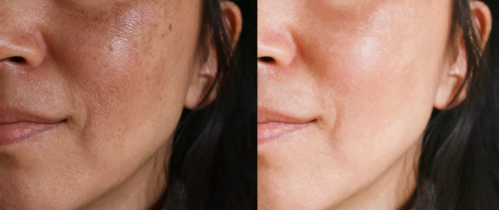 Transform with 1 or 3 PicoWay Resolve Fusion Treatment for Melasma or Pigmented Lesions (Up to 50% Off)  - Primary Image