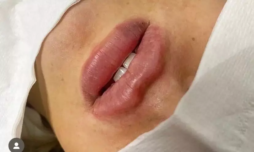 Transform Your Look: Dermal Filler with Consultation