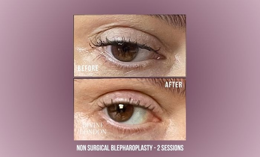 Image 6: Polynucleotides Regenerative Treatment at Divine Aesthetics in London