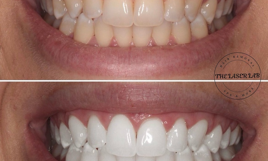 Image 4: Brighten Your Smile and Boost Your Confidence With Teeth Whitening