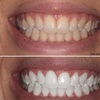 Image 4: Brighten Your Smile and Boost Your Confidence With Teeth Whitening