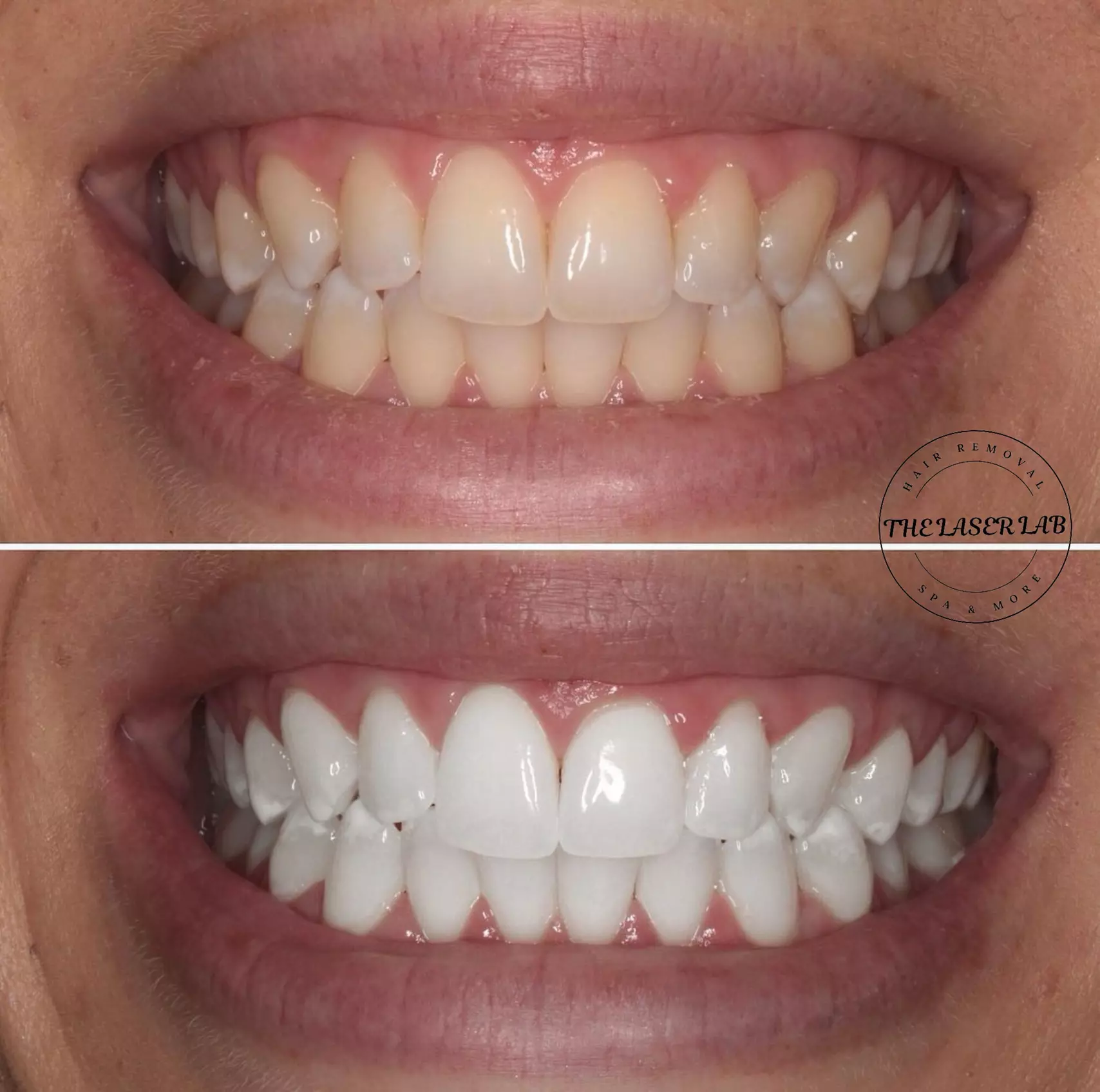 Achieve a Brighter Smile at The Laser Lab and Save Up to 79% Off - Second Medium