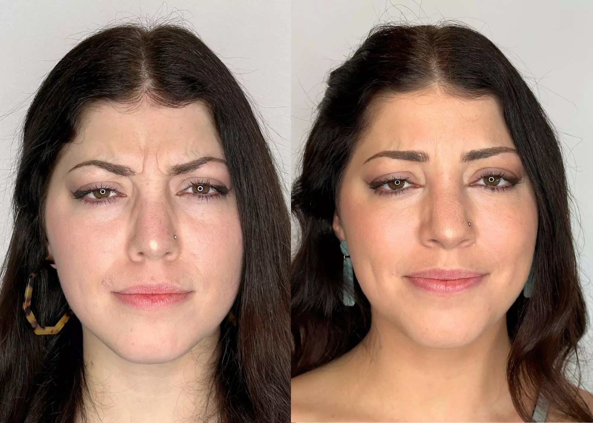 Transform Your Skin with FDA-Approved Dysport or Jeuveau, & Restylane Filler at Forever Young Aesthetics  - Second Medium