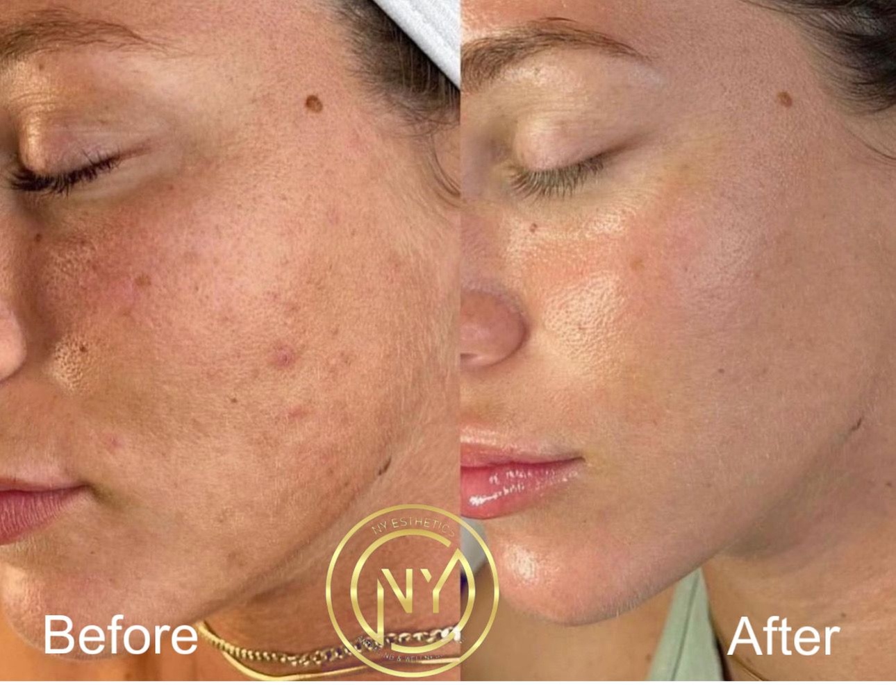 Up to 62% Off on Laser Skin Resurfacing - Branded