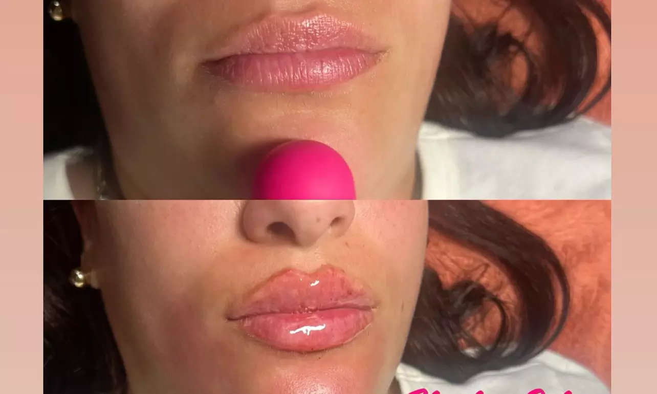 Up to 36% Off on Lip Enhancement at Flawless Extensions - Primary Image