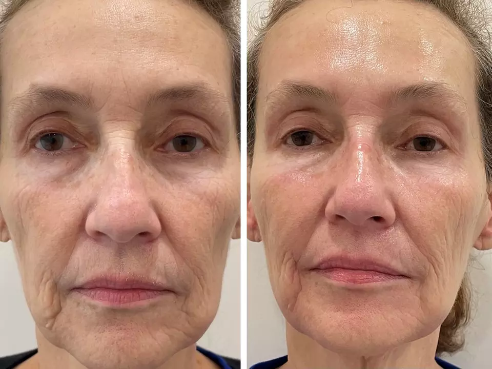 Up to 26% Off on HydraFacial at Skin Plus Beauty - Second Medium