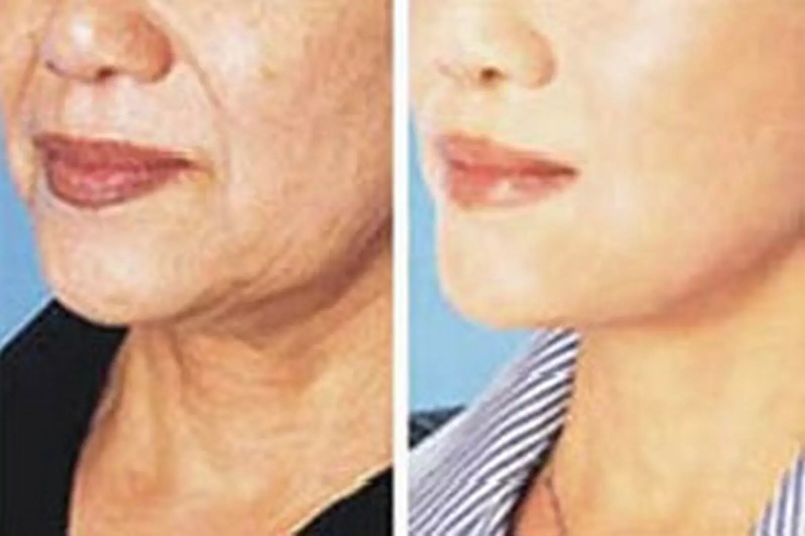 Up to 55% Off on Facial - Anti-Ageing at United Kingdom
