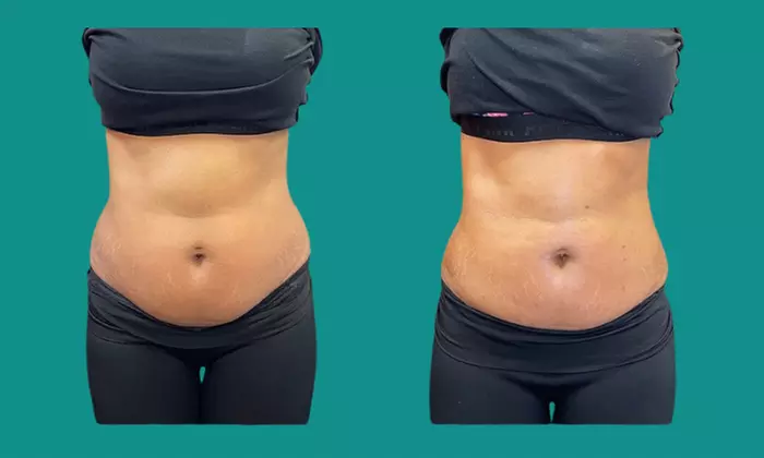 Tay Milz Aesthetics offers a 360 Snatch or Tummy Tuck with up to 49% off for an unmatched body contouring experience. - Second Medium