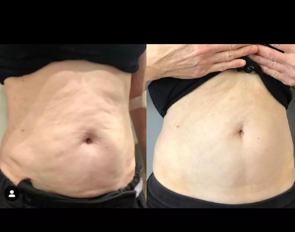 Up to 61% Off on Laser Skin Resurfacing - Branded at Your Vitality Flagstaff - Second Medium