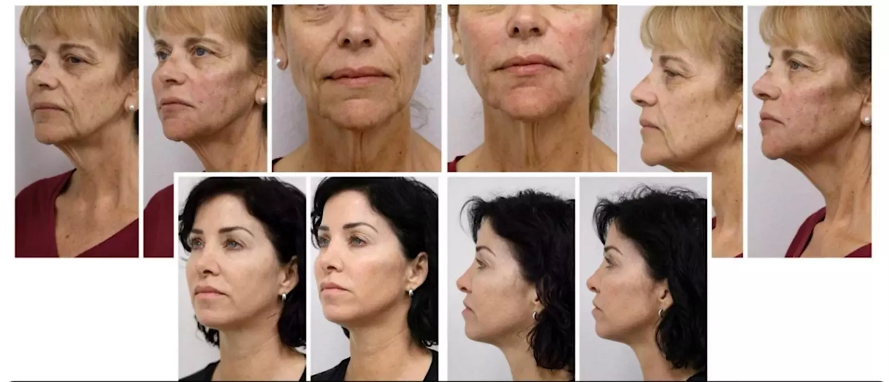 Up to 18% Off on Injection - Organic Filler at HolliBalance Well-Being Center - Primary Image