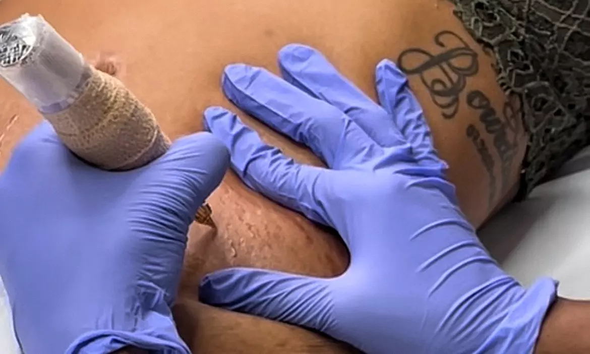 Up to 54% Off on STRETCH MARK REMOVAL at Blend Ink Studio - Primary Image