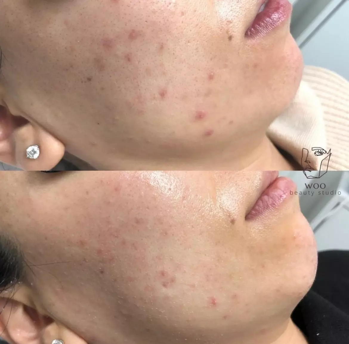 Up to 64% Off on Acne Treatment at Woo Beauty Studio - Second Medium