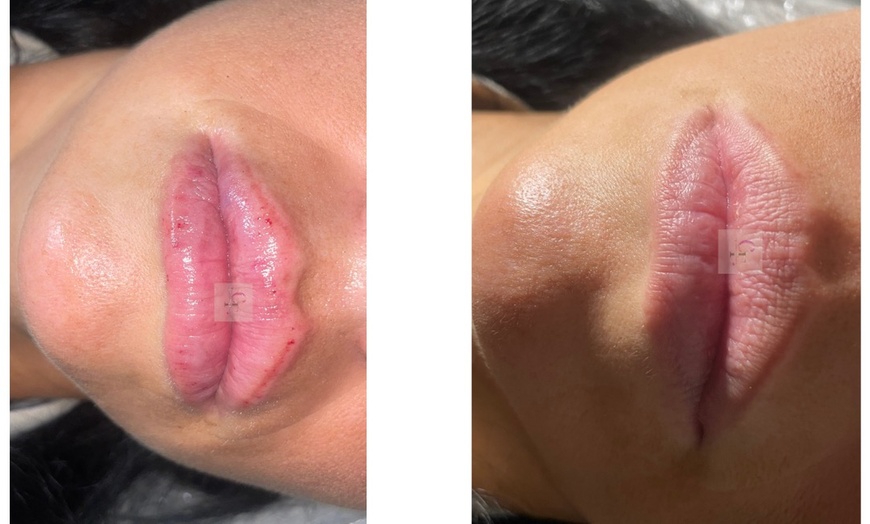Image 3: Up to 30% Off on Facelift - Non-Surgical at Cynlessfillers