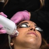 Image 3: Microneedling with Laser Resurfacing for the Hands, Lower Eyes, Neck, or Full Face at Loma Laser (Up to 47% Off)