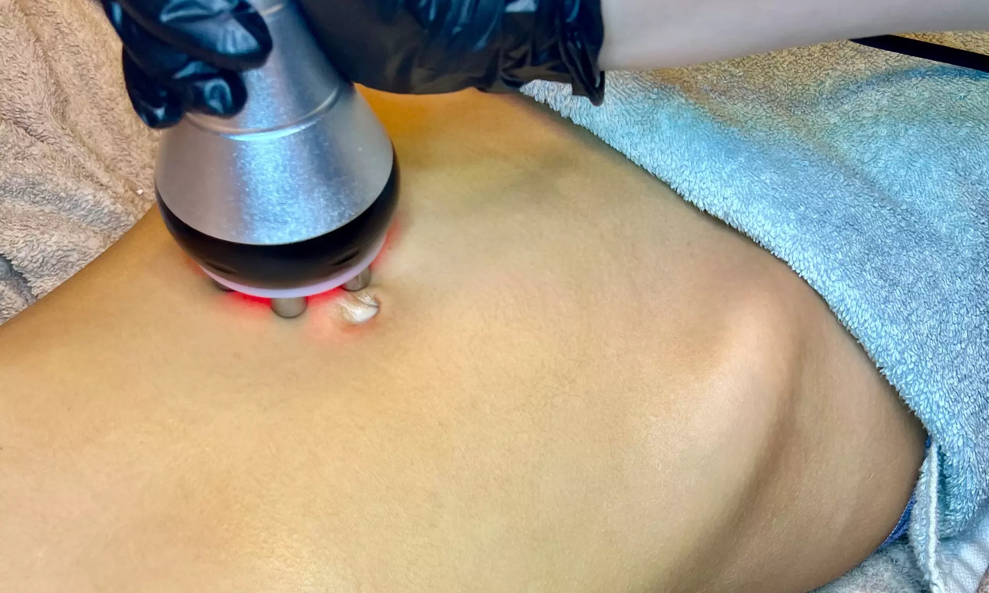 Glow Up Spa offers radio frequency skin tightening with up to 54% off, including single and package options for firmer skin - Primary Image