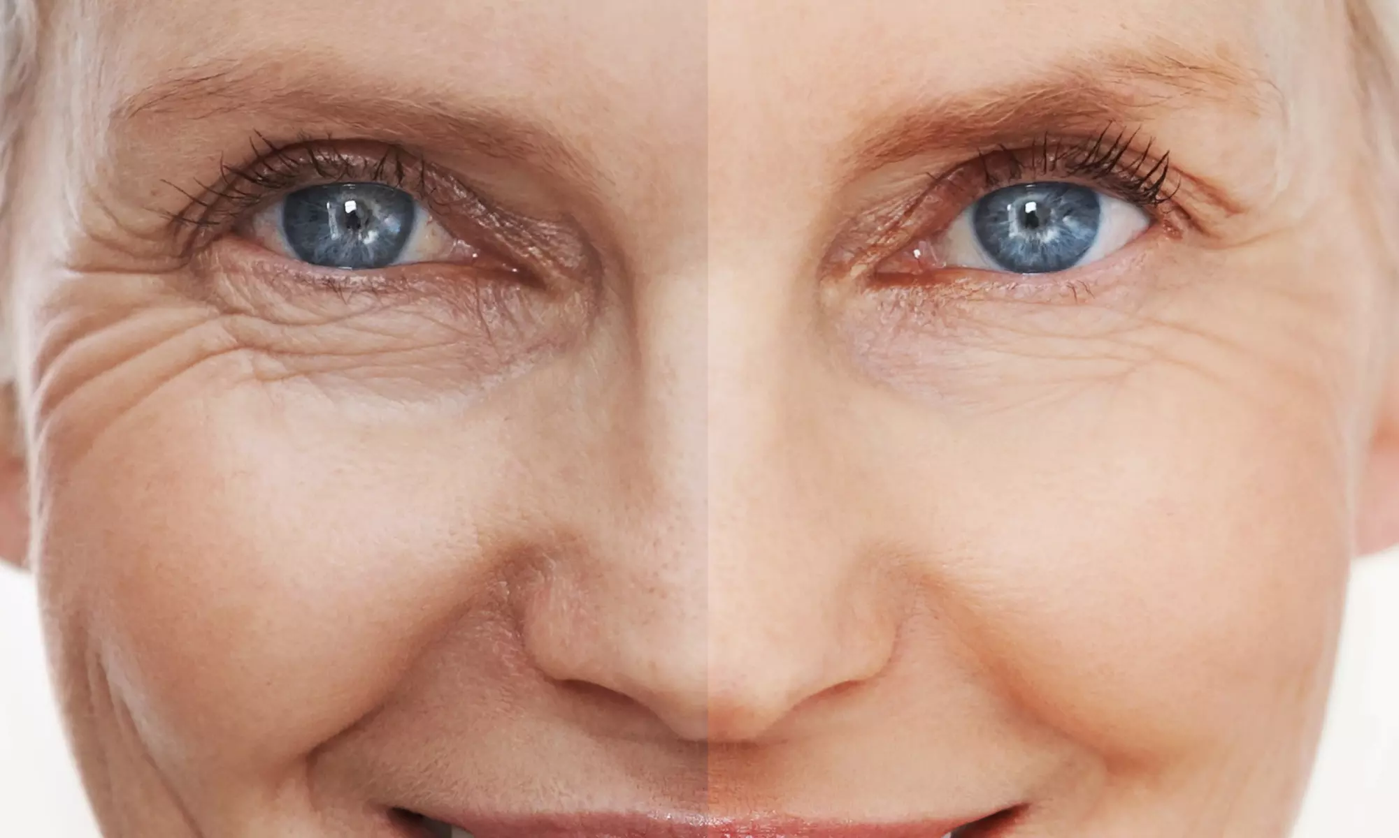 Up to 53% Off on Injection - Dermal Filler at UK Aesthetics Lounge