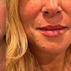 Image 4: Up to 26% Off on Injection - Filler and Freezer at Age Management Optimal Wellness
