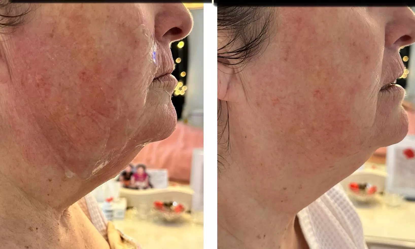 Up to 65% Off on Facelift - Non-Surgical at Velvet Vanity By Puja