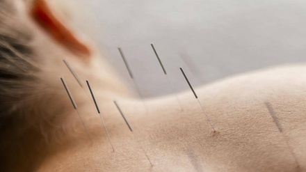 Acupuncture Consultation + Treatment  Includes Complimentary Full-Body Red Light Therapy - Bella Derma Boca Spa