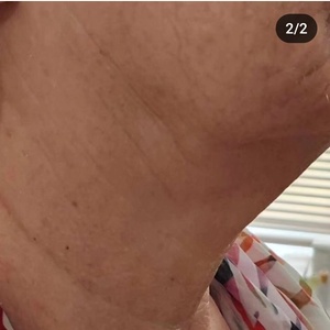 HIFU full face and neck , one session - Famcare Medical Practice