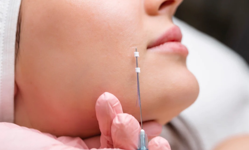 Image 1: Experience a PDO Threads Lift for a Youthful Look