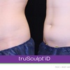 Image 4: Experience Non-Invasive Fat Reduction with TruSculpt