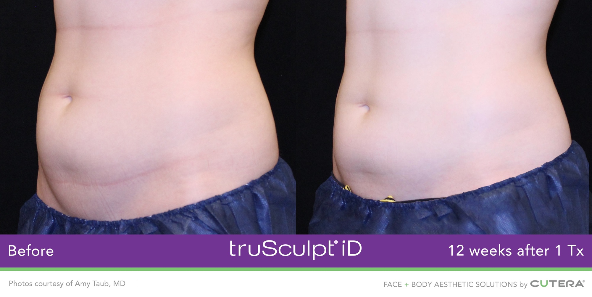 Experience Non-Invasive Fat Reduction with TruSculpt