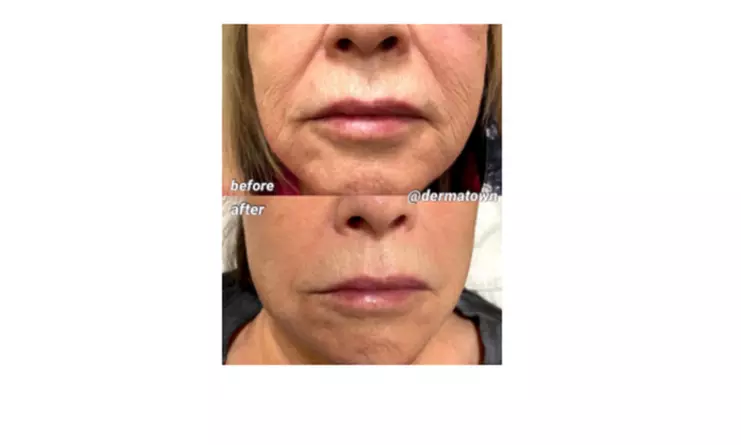 Achieve Radiant Skin with Fractora Skin Tightening Sessions