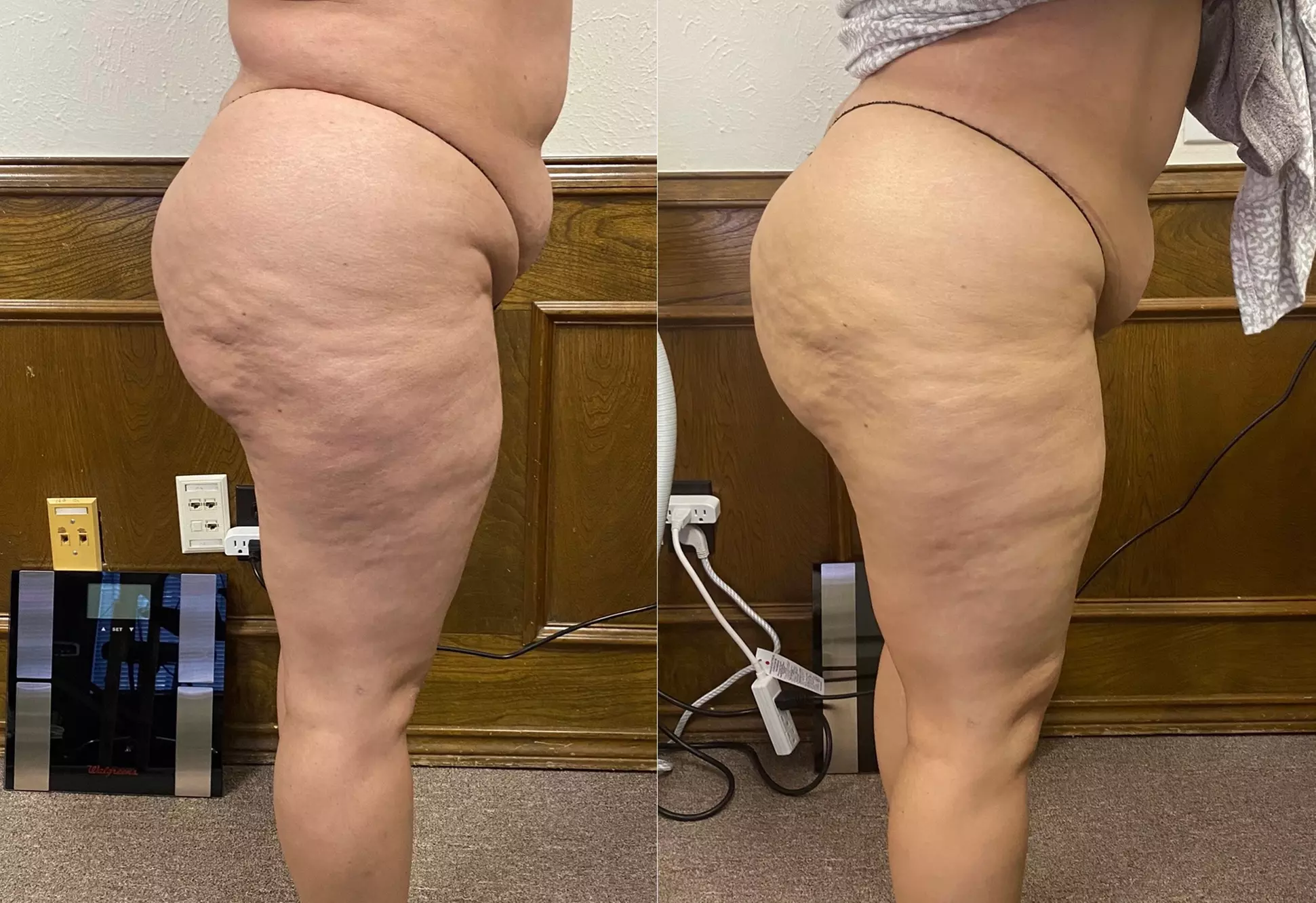 Non-Surgical Butt Lift Sessions for a Firmer Silhouette