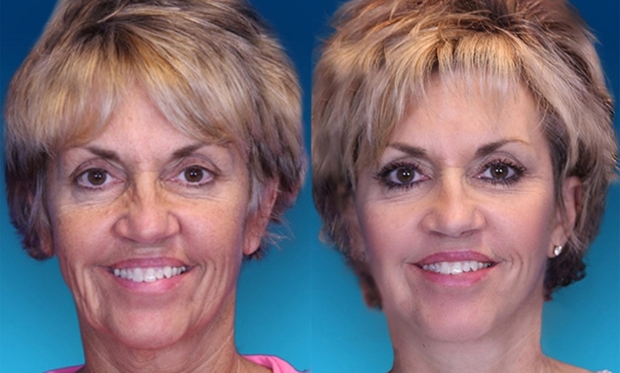 Image 4: Revitalize Your Skin with Co2 Laser Resurfacing Treatment