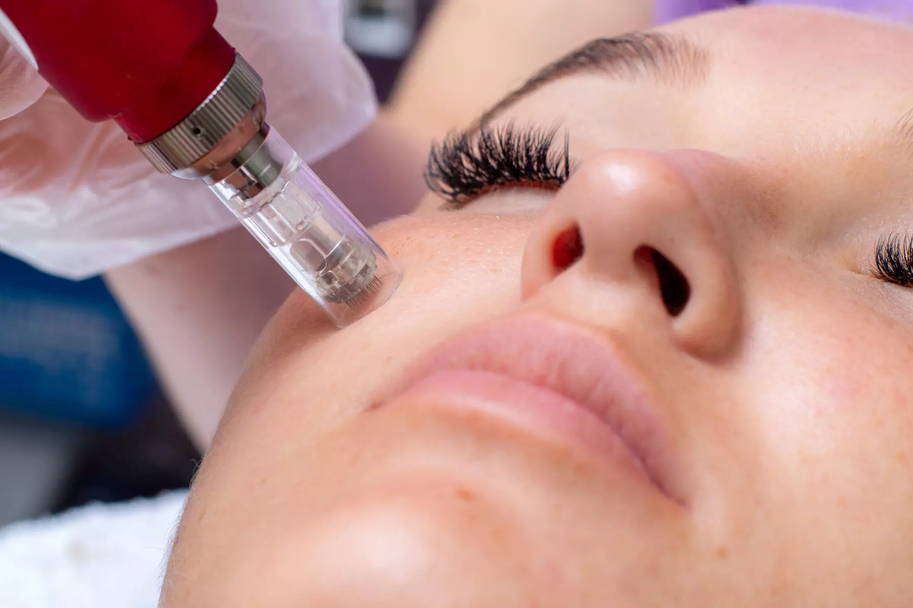 Up to 50% Off PRP Facial with Advanced Microneedling Treatment