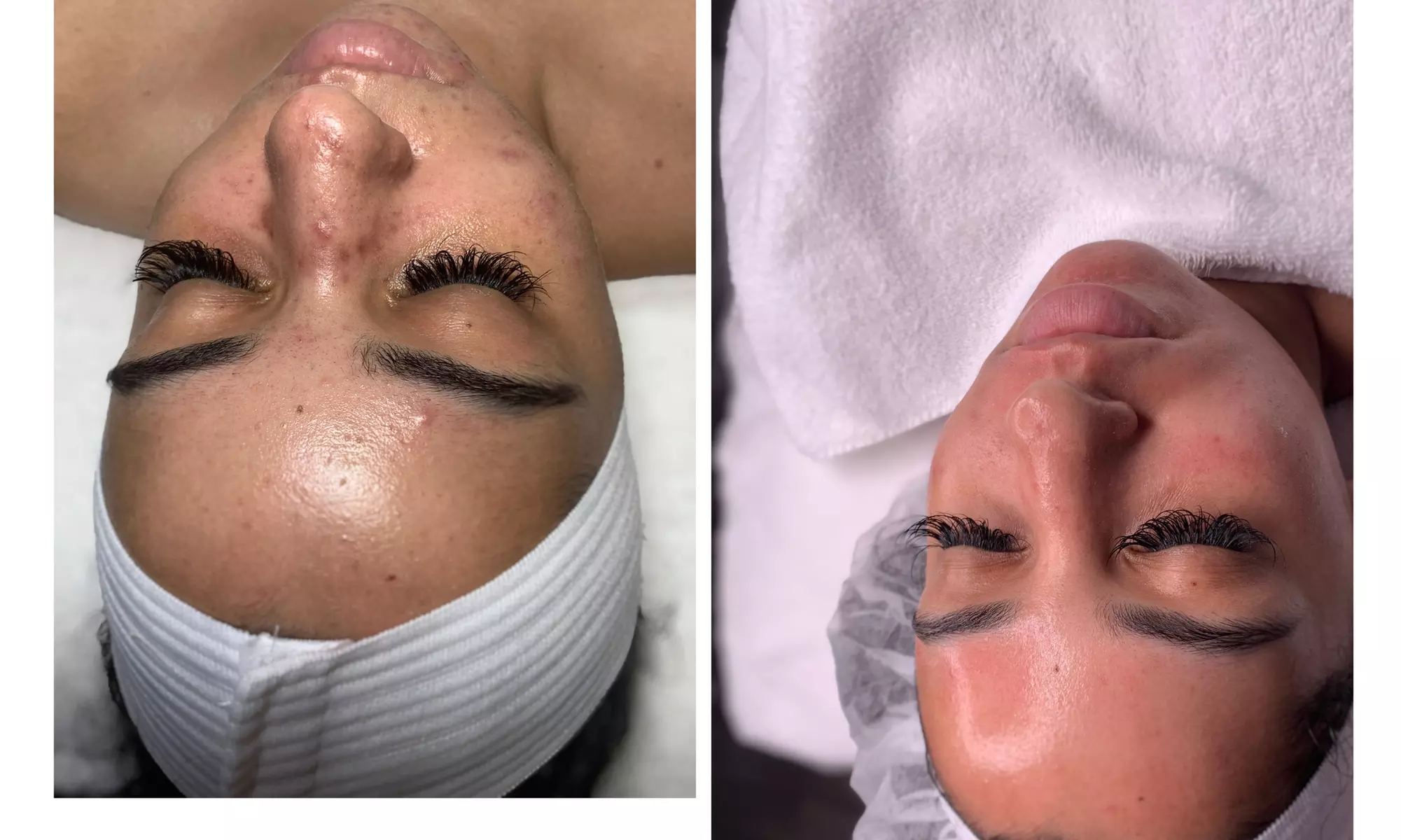 Up to 46% Off on Micro-Needling at Posh Body Lounge - Second Medium