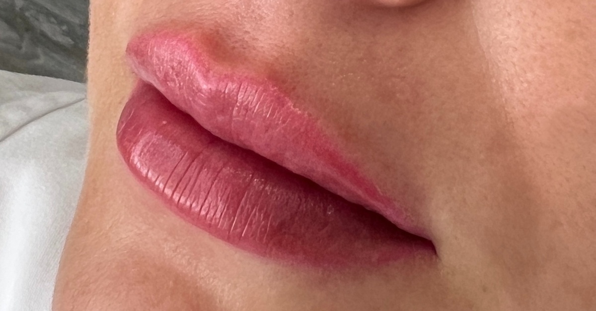 Inyección de ácido hialurónico en labios en Madrid